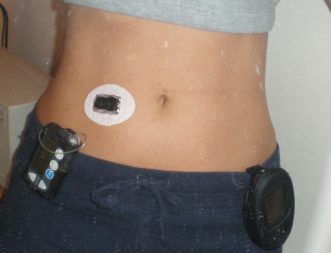 Medtronic Artificial Pancreas >> DiabetesMine – CGM Business Battle: Medtronic Offers Dexcom Trade-In, Promotional Pitch Medtronic Artificial Pancreas >> DiabetesMine – CGM Business Battle: Medtronic Offers Dexcom Trade-In, Promotional Pitch